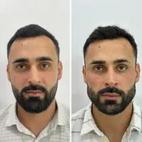 آموزش کاشت مو فیلر ژل بوتاکس نخ لیفت لیزر مو فشیال|خدمات آموزشی|اصفهان, ملک‌شهر|دیوار