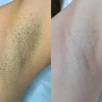 لیزر فرونا، با تضمین جوابدهی