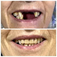 پروتز دندان متحرک اقساط