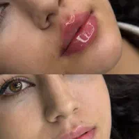 مدل ژل و بوتاکس توسط پزشک فوری