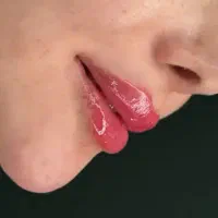 چربی ،ژل،بوتاکس،پی آرپی،بلفاروپلاستی
