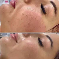 جوانسازی و پلاسماتراپی و مزونیدلینگ