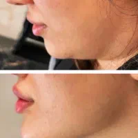 تخفیف فوق العاده خدمات ژل و بوتاکس در مطب|خدمات آرایشگری و زیبایی|شاهینشهر, بوستان حافظ|دیوار