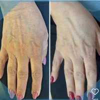 پوست و مو با متد اصولی PRP