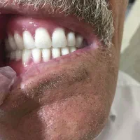 ساخت دندان مصنوعی