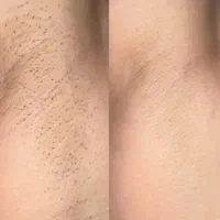 با قیمت های پارسال لیزر کن