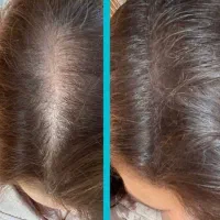 رشد چند برابر موها سر ، مژه ها و ابرو ها
