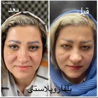 بلفاروپلاستی،لیفت صورت ابرو،اتوپلاستی،لیزر مو تاتو|خدمات آرایشگری و زیبایی|تبریز, |دیوار