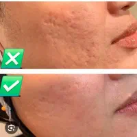 آموزش میکرونیدلینگ ،مزوتراپی سر و صورت