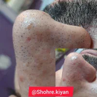 پاکسازی پوست|خدمات آرایشگری و زیبایی|اصفهان, شهرک سلامت|دیوار