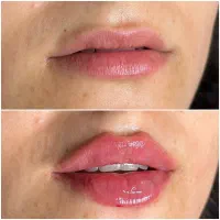 چالگونه با نخ جذبی،تزریق ژل و‌‌ بوتاکس،انواع مزو