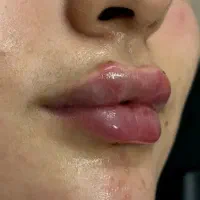 جشنواره تخفیف ژل و بوتاکس و جوانساز|خدمات زیبایی و سلامت|شیراز, فرهنگ شهر|دیوار