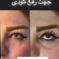تخفیف ویژه تزریق فیلروبوتاکس باماندگاری بالا|خدمات آرایشگری و زیبایی|فلاورجان, |دیوار