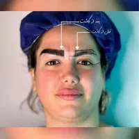 مرکز تخصصی ساکشن غبغب بوکال فت بلفارو کاشت ابرو|خدمات آرایشگری و زیبایی|تهران, پونک|دیوار