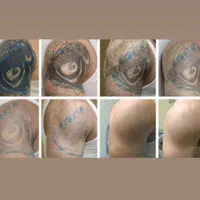 لیزر مو زائد/لیزر تتو/پاک کردن تتو/روشن سازی پوست|خدمات آرایشگری و زیبایی|اصفهان, خلجا|دیوار
