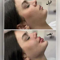 تزریق فیلر بوتاکس،نخ لیفتینگ بانصف قیمت بازار
