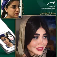 لیپوساکشن فقط۲۲تومن ژل صورت تزریق چربی باسن صورت