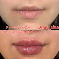 جشنواره تزریق فیلر و ژل و بوتاکس در قلب پزشکی مشهد|خدمات آرایشگری و زیبایی|مشهد, احمدآباد|دیوار