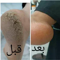 آموزش و خدمات پرسینگ و پدیکورتراپی تخفیف ۸۰ درصدی|خدمات آرایشگری و زیبایی|کرج, باغستان|دیوار