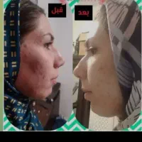 کیت آنتی آکنه فوری