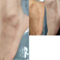 پاک کردن تتو///خدمات لیزر کیوسوئیچ و پیلینگ کربن|خدمات آرایشگری و زیبایی|صدرا-فارس, فاز ۱|دیوار