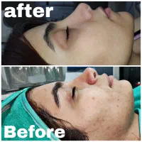 پاکسازی پوست،درمان منافذ باز،آکنه،تخلیه سر سیاه|خدمات آرایشگری و زیبایی|اهواز, سپیدار|دیوار