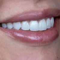 شرایط استثنایی کامپوزیت ونیر