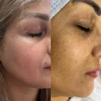 مدل پاکسازی صورت و فیشیال فوری فقط هزینه مواد|خدمات آرایشگری و زیبایی|اهواز, پردیس دو|دیوار