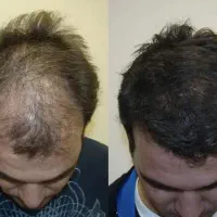 مشاوره کاشت مو،ابرو و کلیه خدمات زیبایی رایگان|خدمات آرایشگری و زیبایی|مشهد, فرهنگ|دیوار