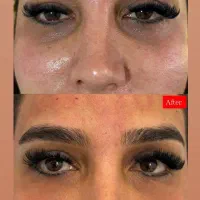 تزریق پی ار پی،مزو مزوژل(تخفیفات افتتاحیه)|خدمات زیبایی و سلامت|شیراز, چوگیاه|دیوار