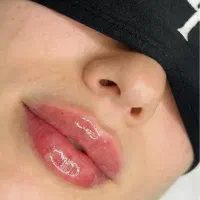 تخفیف ۳۵ درصدی تزریق بوتاکس و فیلر کلینیک زیبایی