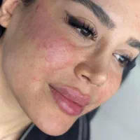 کلینیک تزریق ژل بوتاکس آنزیم فیلر لب شقیقه|خدمات آرایشگری و زیبایی|کرج, گوهردشت|دیوار