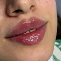 اف  ویژه فقط تا اخر هفته فول فیس  و ژل و بوتاکس
