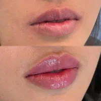 تخفیف استثنایی فیلرلب،بوتاکس،مزو