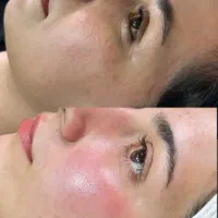 پاکسازی پوست فقط ۴۰۰ به مدت ۳ روز