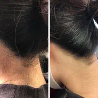 کلینیک لیزر موهای زائد|خدمات آرایشگری و زیبایی|خمینیشهر, |دیوار