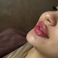 آموزش تخصصی فیلر بوتاکس مزو prp فیلر بادی آنزیم