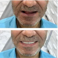 دندان مصنوعی دندانسازی بامجوز رسمی و ۵۰درصدتخفیف|پزشکی|مشهد, پایین خیابان|دیوار