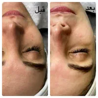 فیشیال و پاکسازی پوست و زیبایی|خدمات آرایشگری و زیبایی|تهران, دانشگاه شریف|دیوار