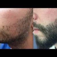 ریش پرپشت میخوای