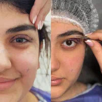 بلفاروپلاستی /پلک پایین پلک بالا