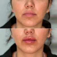 ژل بوتاکس لیزر فیشال مزوتراپی پاکسازی