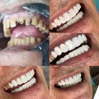 کامپوزیت دندان روکش لمینت با قیمت مناسب و اقساط|خدمات آرایشگری و زیبایی|ری, شهرری|دیوار