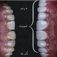 لمینیت و کامپوزیت|خدمات آرایشگری و زیبایی|تهران, پاسداران|دیوار