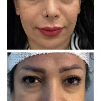 جشنواره ویژه کاشت مو و ابرو|خدمات آرایشگری و زیبایی|رشت, بوسار|دیوار