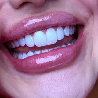 کامپوزیت دندان با ۸۰درصد تخفیف ویژه
