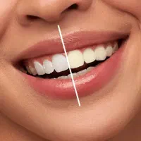 سفید کننده دندان|آرایشی، بهداشتی، درمانی|تهران, ترمینال جنوب|دیوار