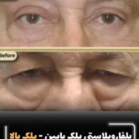کاشت مو و ابرو/بوتاکس/بلفاروپلاستی/رفع غبغب/اقساطی|خدمات آرایشگری و زیبایی|تهران, سعادت‌آباد|دیوار