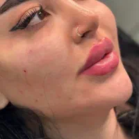 انجام خدمات و آموزش ژل بوتاکس و ...