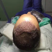 جشنواره کاشت مو با تخفیف ۵۰ درصدی